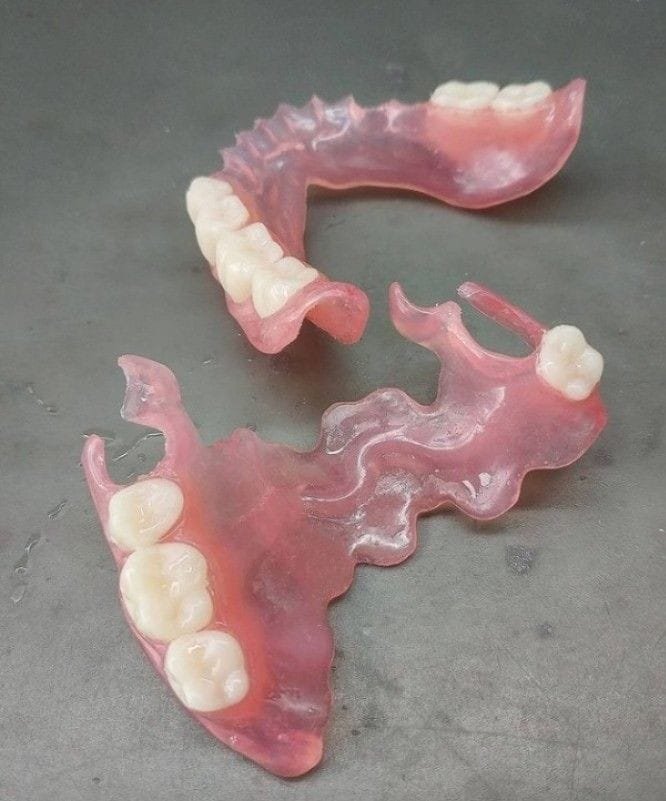 Exemple de prothèse dentaire 2