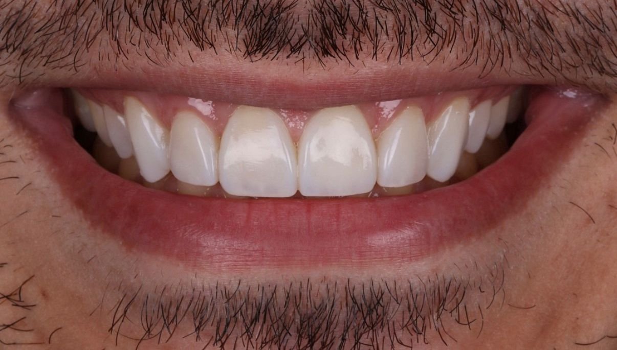 Sourire Après Cas 3