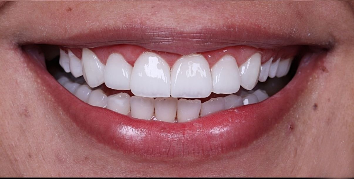 Sourire Après Cas 2