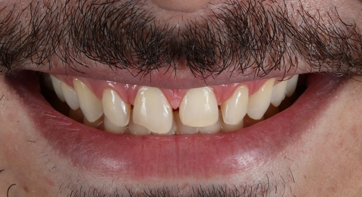 Sourire Avant Cas 3